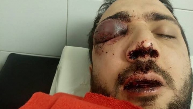 La noche platense, ley de la selva: patovicas de bar Mute desfiguraron a un pibe que podría perder un ojo